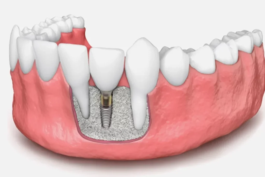 An image showing how the bone grafting is performed on teeth.