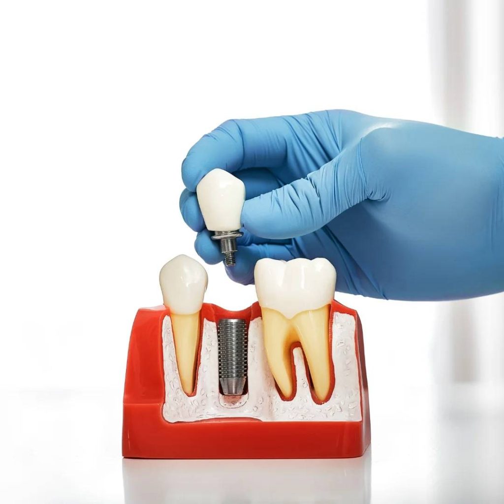Implant Dentistry London ON