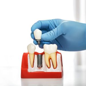 Implant Dentistry London ON