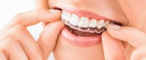Invisalign London ON treatment