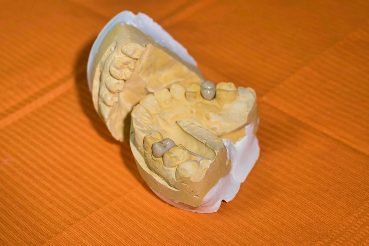 Dental lab model displaying crown restorations on prepared teeth against an orange background