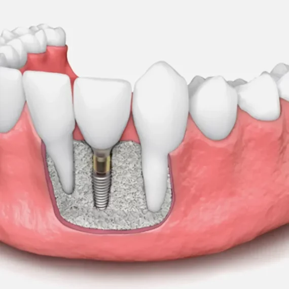 An image showing how the bone grafting is performed on teeth.